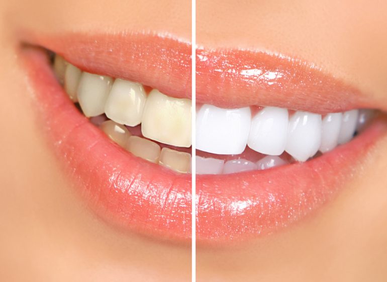 Teeth Whitening in Lynn MA